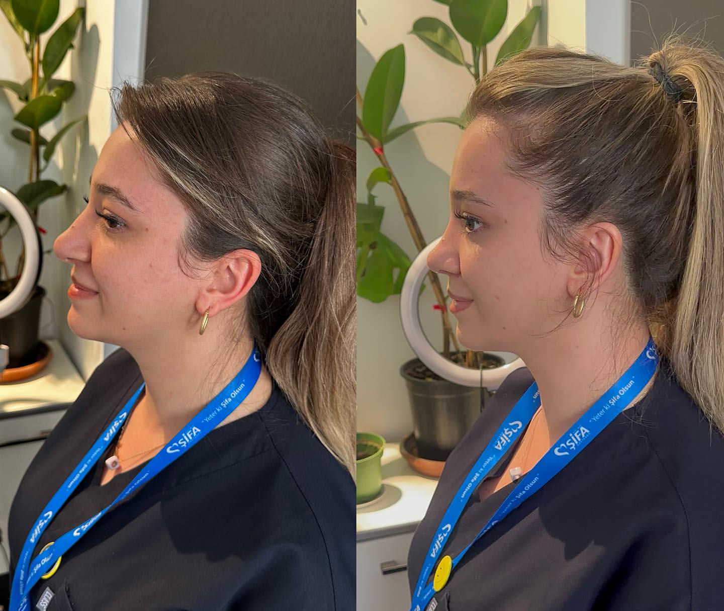 op-dr-sefa-kesan-burun-kepce-kulak-estetigi-0 (47)