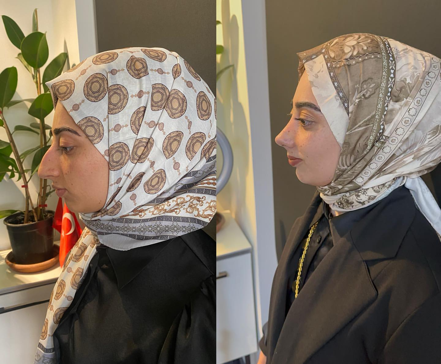 op-dr-sefa-kesan-burun-kepce-kulak-estetigi-0 (70)