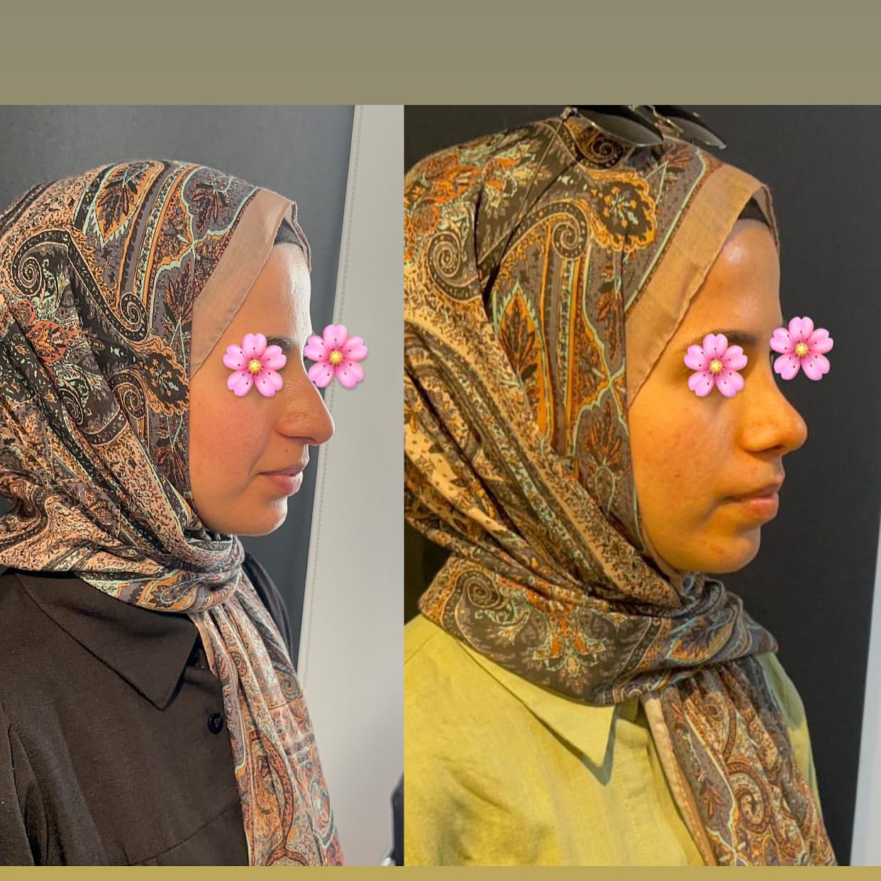 op-dr-sefa-kesan-burun-kepce-kulak-estetigi-0 (71)