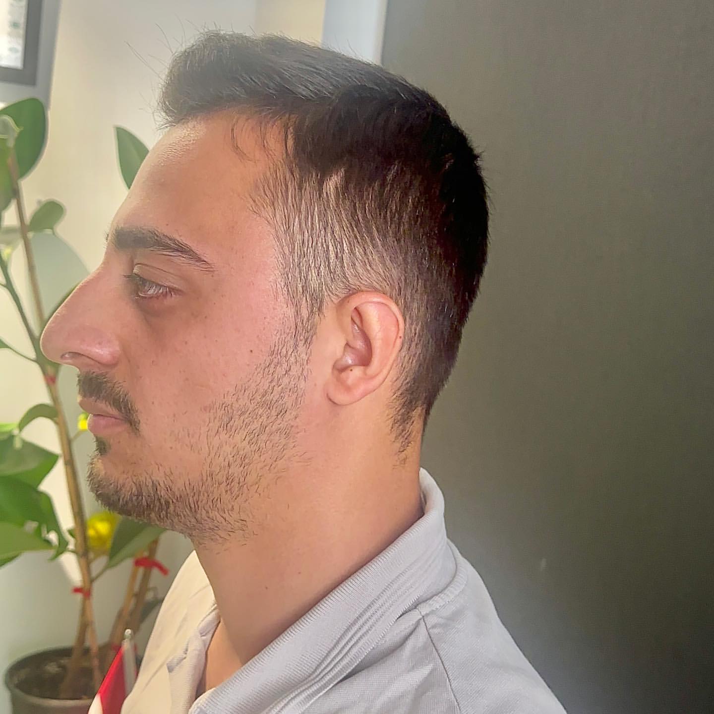 op-dr-sefa-kesan-burun-kepce-kulak-estetigi-0 (80)