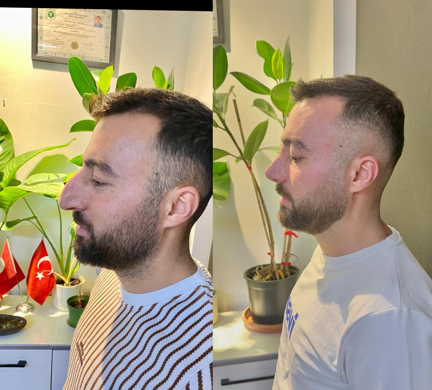 op-dr-sefa-kesan-burun-kepce-kulak-estetigi-01- (6)